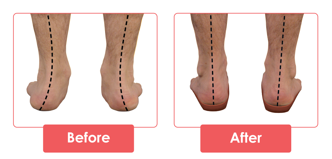 Foot Conditions – Pedistep